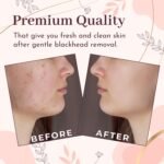 Blackhead Remover Professional Skincare Spot Treatment Blackhead Remover Tool for Blemish Comedone Whiteheads Pimple Popper with Double Sided Soft Touch and Anti-Slip Design - Image 7