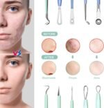 Blackhead Remover Tools MENOLY 10Pcs Pimple Popper Tool Kit, Blackhead Remover Extractor Tools, Pimple Comedone Extractor Acne Kit for Blackhead,Blemish,Zit Whitehead with Leather Bag - Image 4